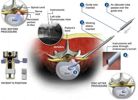 Percutaneous Endoscopic Discectomy