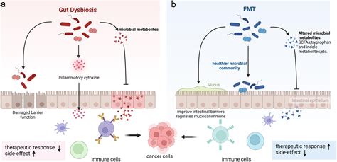 Gut Dysbiosis And Fecal Microbiota Transplantation In Pancreatic Cancer