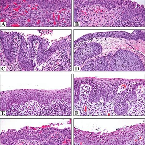 Pdf P And Ki Immunostaining In Atypical Immature Squamous