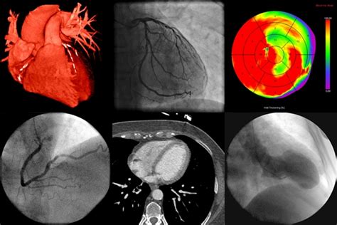 Examining Cardiovascular Disease In Ankylosing Spondylitis