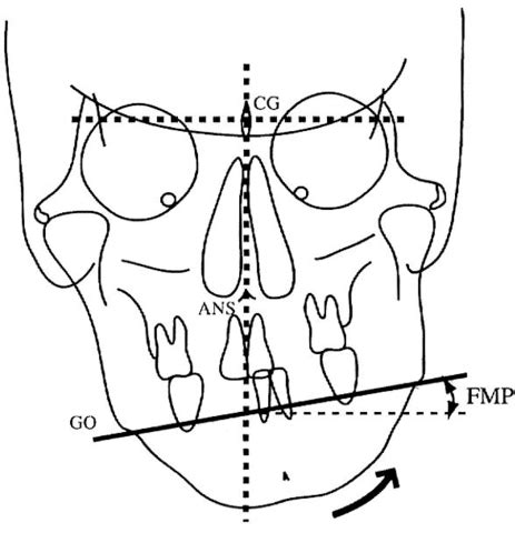 Cephalometric Graphical Evaluation Of The Exact Location Of Transverse