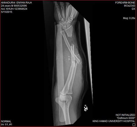 Worst Hand Forearm Injury Open Fracture Called Compound Fracture