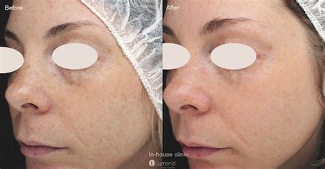 Stellar M Ipl Resurfx Fox Facial Plastic Surgery Center