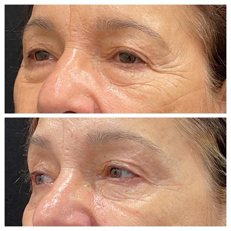 Non Surgical Eye Lift Exilis Ultra Rejuve Medspa Newcastle