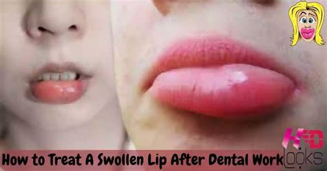 How To Treat A Swollen Lip After Dental Work Very Easy Steps