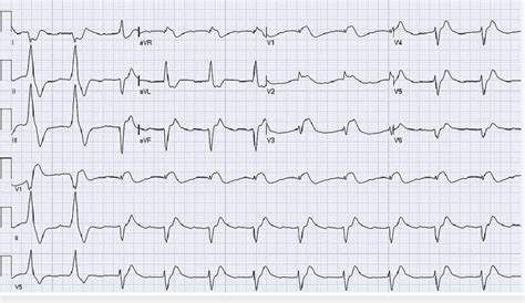 ECG Showing Normal Sinus Rhythm With ST Segment Elevation In Precordial