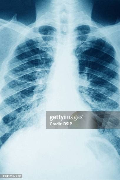 27 Sarcoidosis Lungs Stock Photos, High-Res Pictures, and Images ...