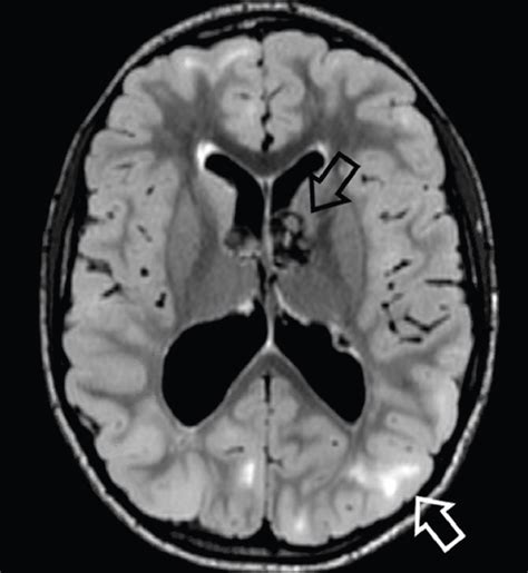 Tuberous Sclerosis Complex Practical Neurology