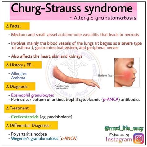 Churg Strauss Syndrome MEDizzy