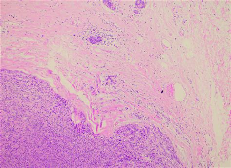 Tumor Infiltration Well Separated From Mammary Stroma As Well As