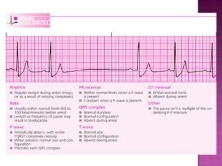 ECG: Multifocal Atrial Tachycardia | PPT