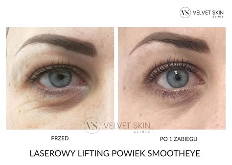 Laserowy Lifting Powiek SmoothEye Fotona Velvet Skin Clinic