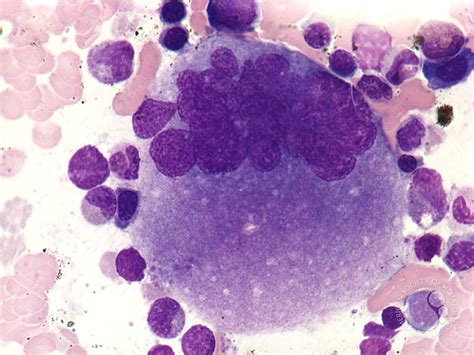 Megakaryocyte With Multiple Lobes Nucleus Medical Laboratories