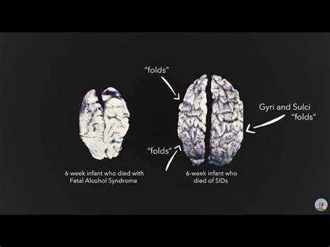 Fetal Alcohol Syndrome And The Brain Youtube