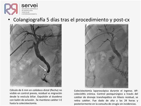 Litotricia Percutánea Con Láser Holmium Para El Tratamiento De La