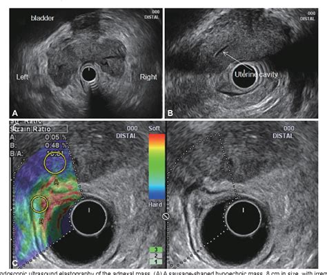 Figure 1 From Primary Fallopian Tube Carcinoma Diagnosed With Endoscopic Ultrasound Elastography