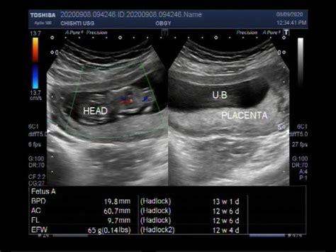 Placenta Previa 3d Ultrasound