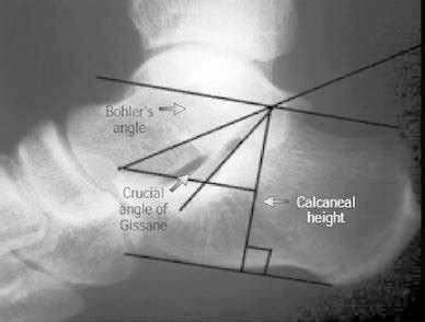 Measurement of Bohler’s angle, the crucial angle of Gissane, and the... | Download Scientific ...