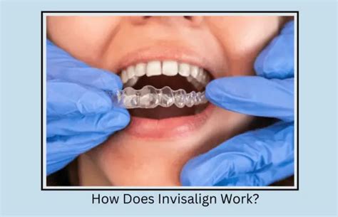 How Does Invisalign Work Know 8 Steps Of Process Oral Health Line