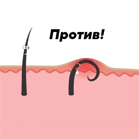 В зоне бикини врастают волосы: Как избавиться от вросших волос после ...