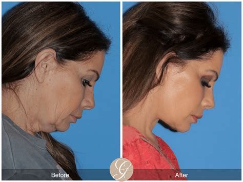 Deep Plane Facelift Before After Photos Dr Sadati FACE Deep Plane