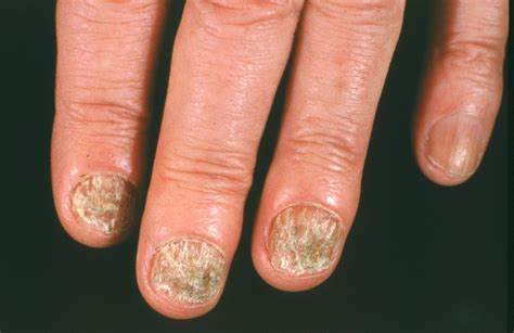 Nail Fungus Foothill Dermatology Medical Center Dermatology