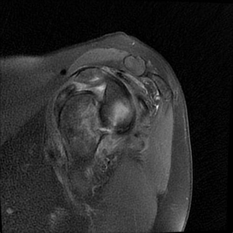 Anterior Shoulder Dislocation With Hill Sachs Defect And Bony Bankart