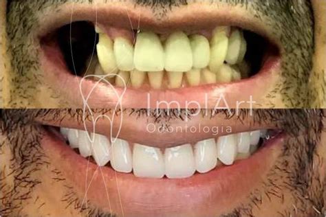 Implante total dental Conheça as 11 etapas do tratamento