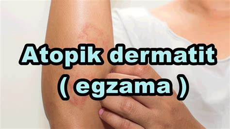 Atopik Dermatit Egzama Binaural Isochronic Enerji Frekans