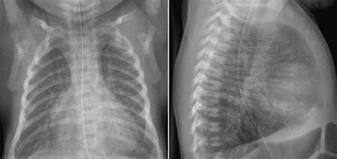 Pulmonary Vascularity Radiology Key