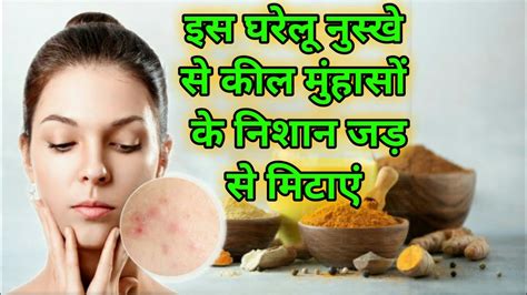 मुंहासों के निशान मिटाने का रामबाण इलाज Pimple Ke Nishan Khatam Karne