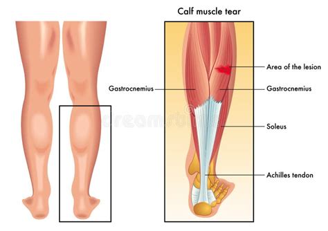 Calf muscle tear stock vector. Illustration of running - 68893791