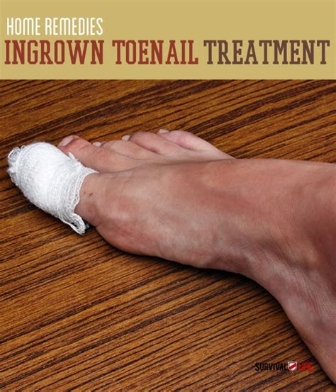 Ingrown Toenail Treatment | Home Remedies | Survival Life