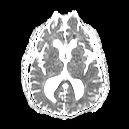 Adult Onset Leukoencephalopathy With Axonal Spheroids And Pigmented