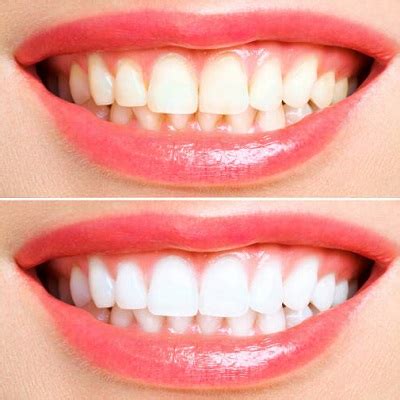 How Much Does Teeth Whitening Cost In Islamabad