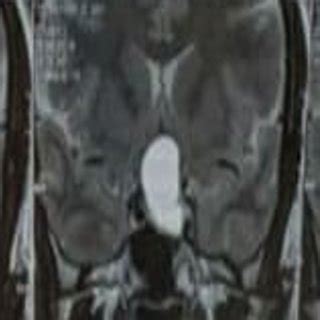 Pre-operative Contrast-enhanced CT scan of brain showing Pituitary ...