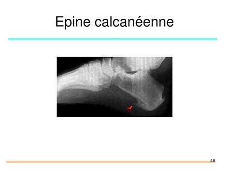 PPT Pathologie péri articulaire membre inférieur PowerPoint