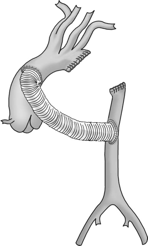 Successful Treatment Of Salmonella Mycotic Aneurysm Of The Descending