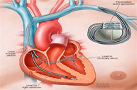 Cardiac Resynchronization Therapy