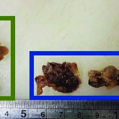 Gross Specimens Of Right Axillary Lymph Nodes Lateral Humeral Node