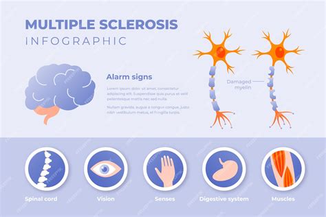 Infografía De Esclerosis Múltiple En Gradiente Vector Premium