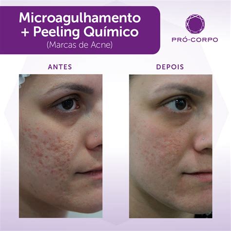 Peeling Químico Eficaz Contra Rugas E Manchas Pró Corpo