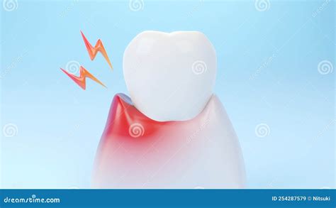 Gums Gum Inflammation Gingival Recession Stock Illustration