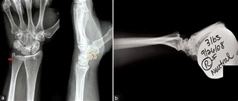 Distal Radioulnar Joint X Ray