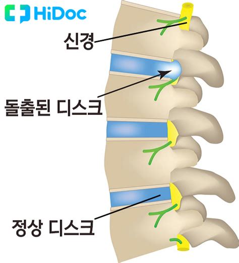 허리디스크 증상