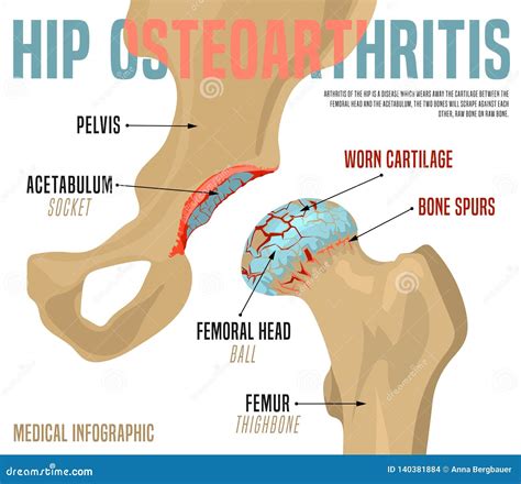 Hip Osteoarthritis Infographic Vector Illustration