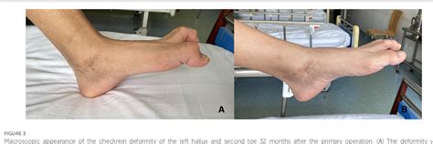 Figure 3 From Posttraumatic Checkrein Deformity Following Isolated