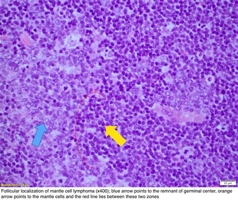 Pathology Outlines Mcl Classic