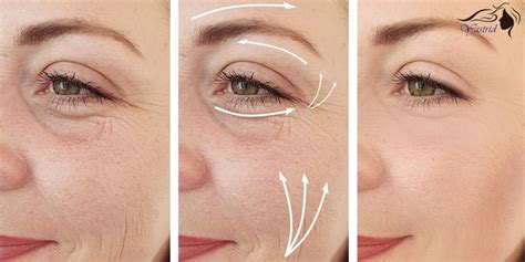 What Is Pdo Thread Lift Eyelids