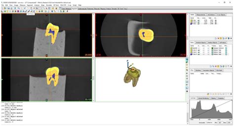 Teeth Restored with Bulk–Fill Composites and Conventional Resin ...